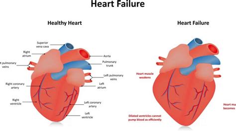 basal lower wall hypokinesis.